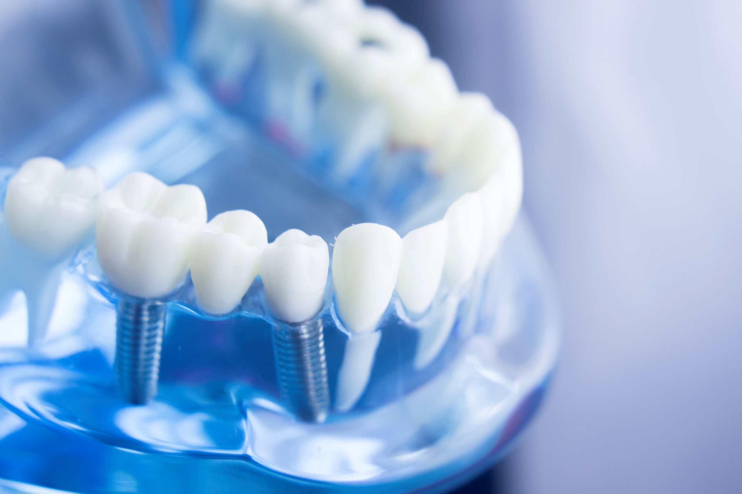 Close-up of a dental implant model showing a set of artificial teeth mounted on blue gums with visible screw bases for the implants.